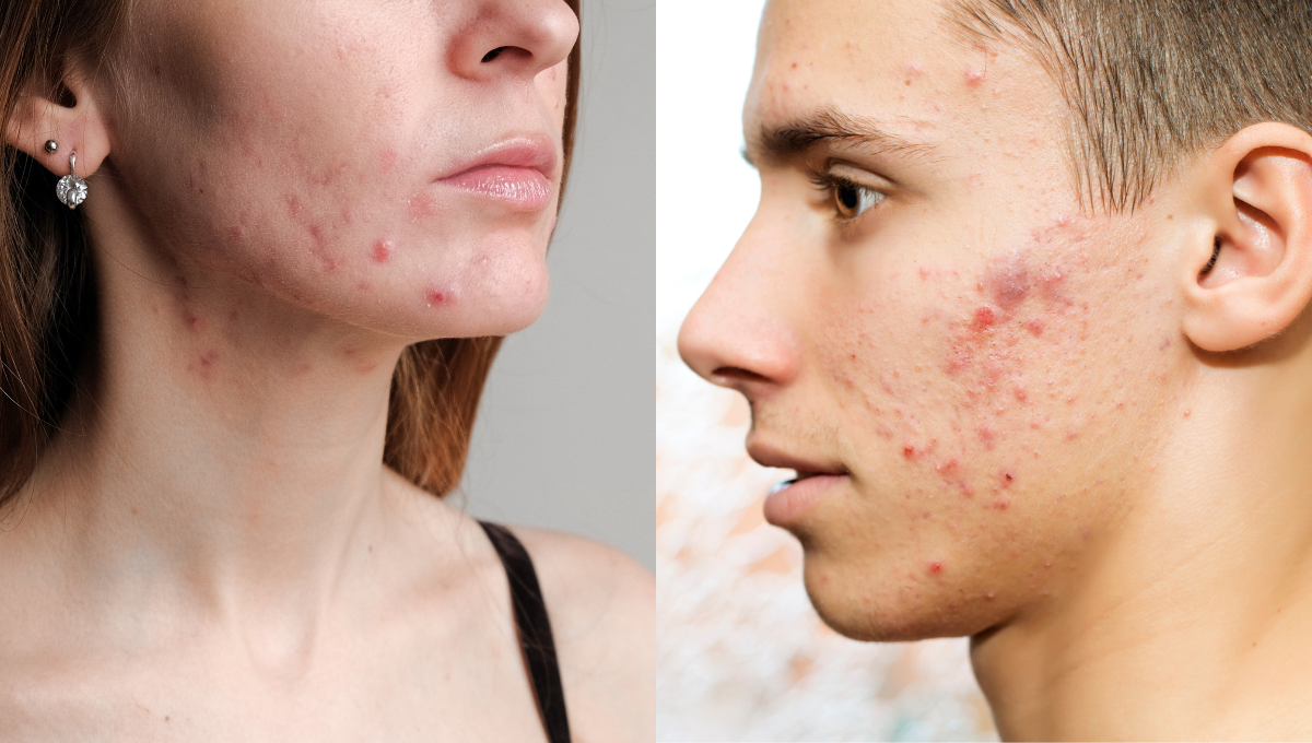 Adult vs Teen Acne ... the difference and how to tackle it!